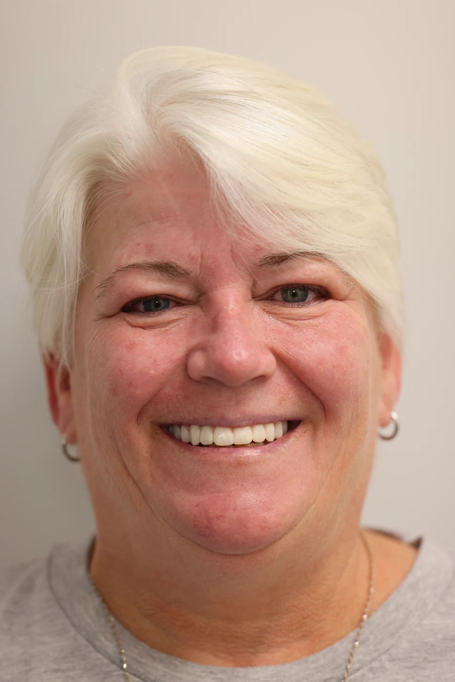 Patient smile after full-arch dental implant treatment, patient case 06