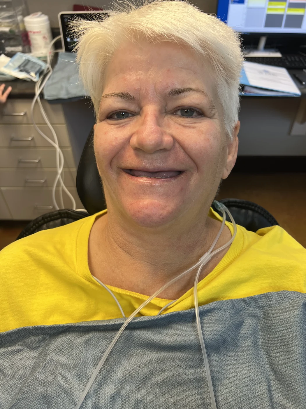 Before full-arch dental implant treatment, patient case 06