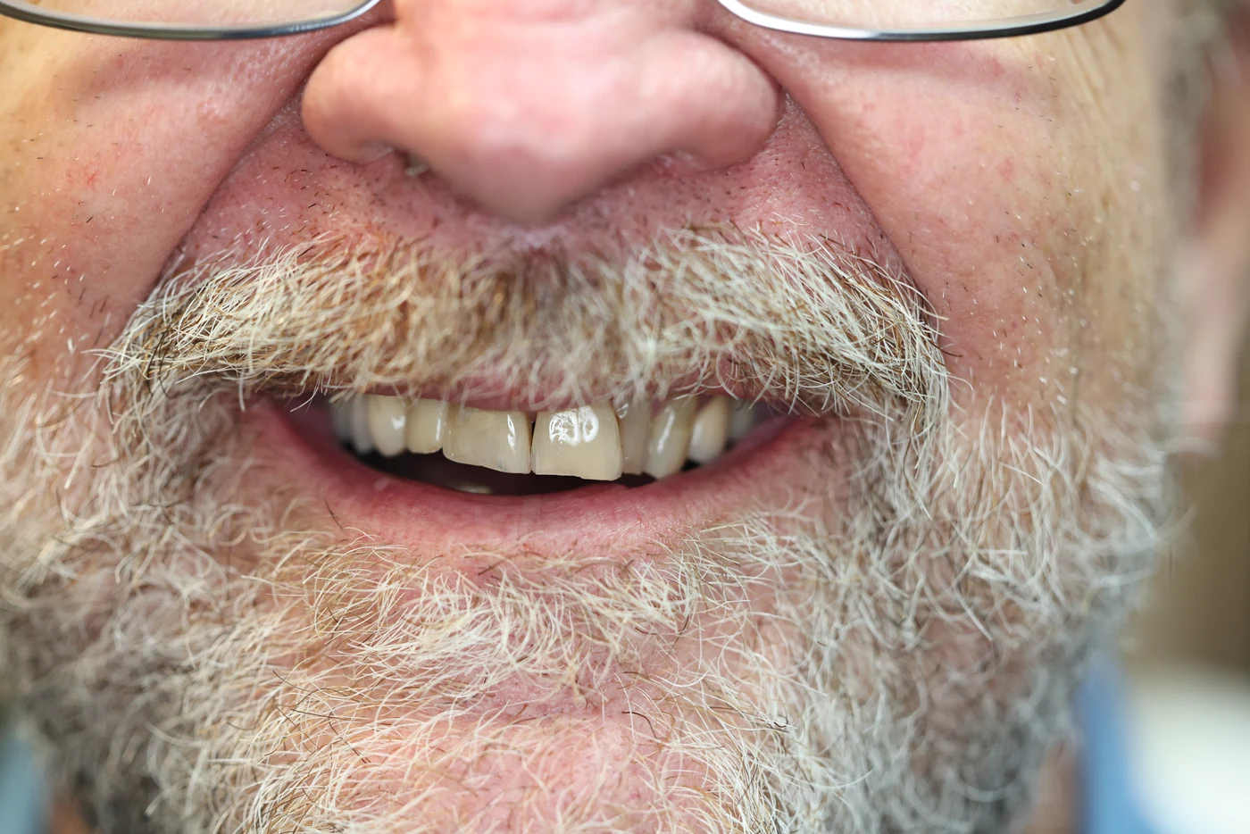 Temporary crown after immediate single dental implant placement, patient case 01